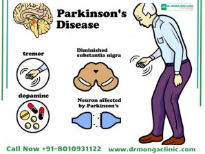 Parkinson specialist near Central Delhi, Delhi || Dr Monga Clinic 8010931122